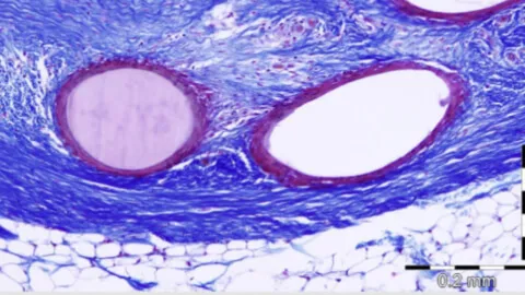 Hernia repair