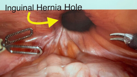 Inguinal hernia hole