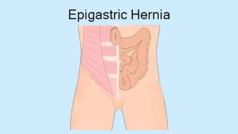 Types of hernia