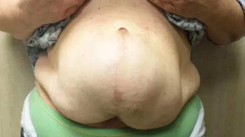 Types of hernia
