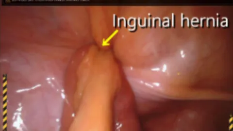Types of hernia