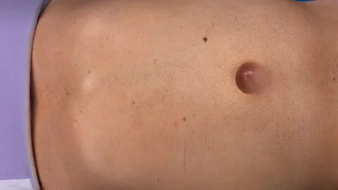Umbilical hernia
