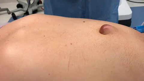 Umbilical hernia