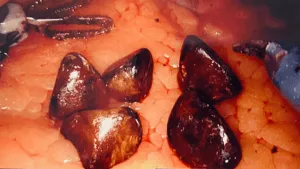 Gallstones in gallbladder