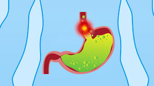 Stomach filled with acid