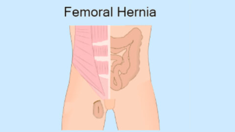Femoral Hernia