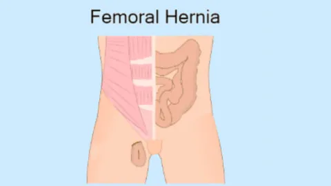 Femoral Hernia