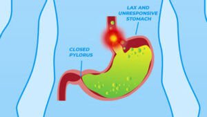 Lax and unresponsive stomach with a closed pylorus
