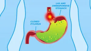 Lax and unresponsive stomach with a closed pylorus