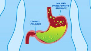 Gastroparesis in stomach