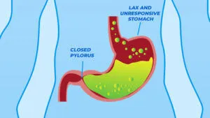 Gastroparesis in stomach