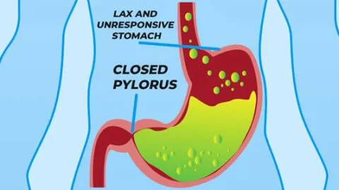 Gastroparesis in stomach