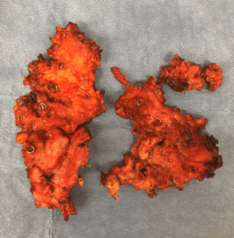 Hernia repair complications