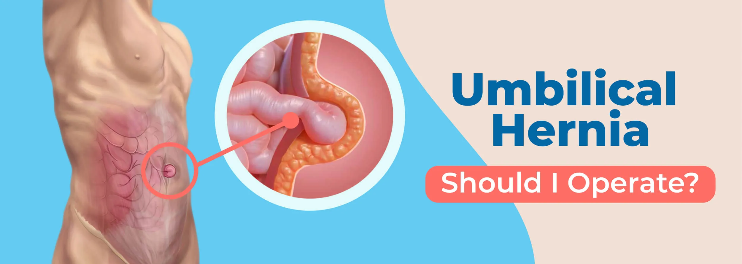 Hernia Umbilical: ¿Cuándo Operar?