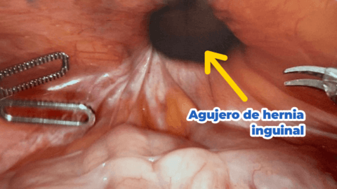 Tipos de hernia