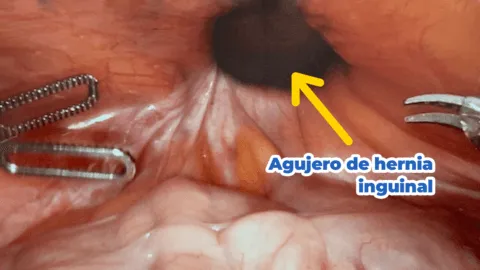 Tipos de hernia