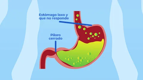 Gastroparesia en el estómago