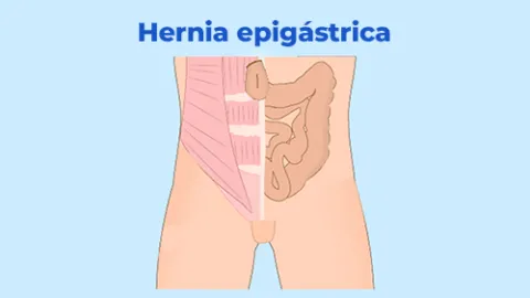 Tipos de hernia