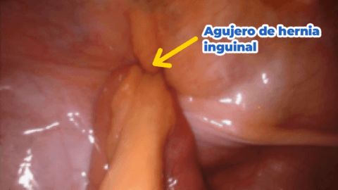 Tipos de hernia