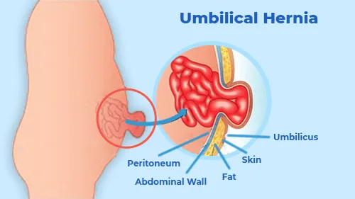 HerniaUmbilicalEN