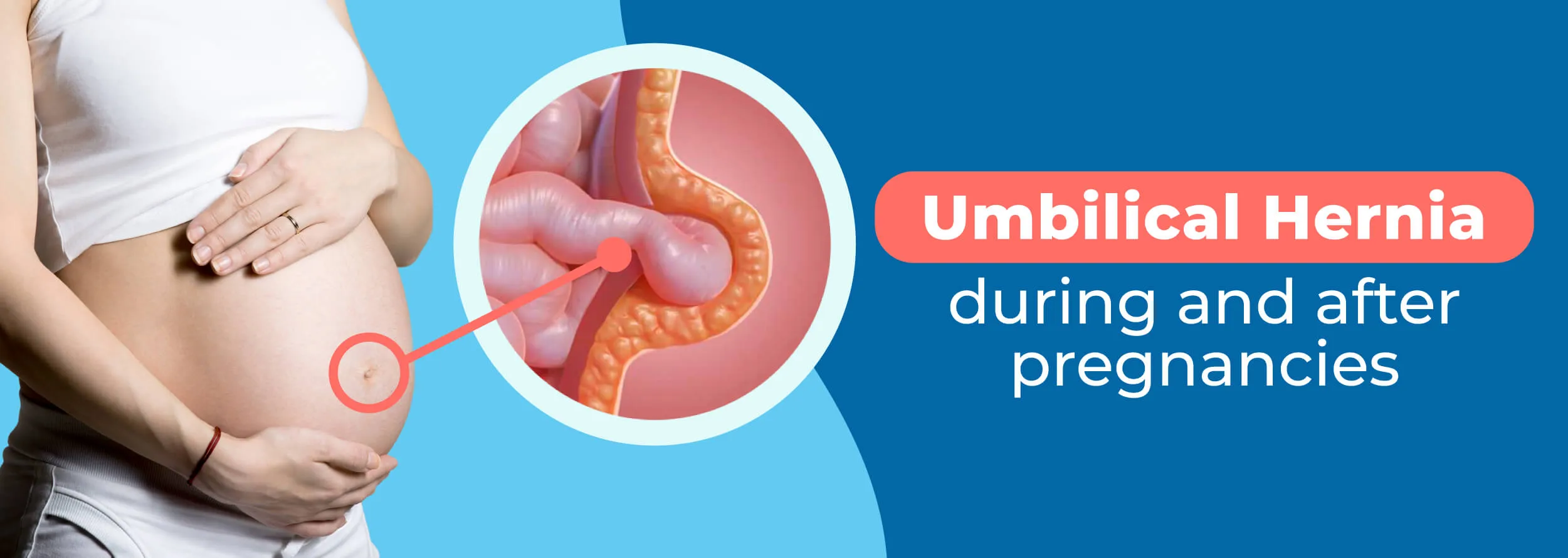 Umbilical Hernia During and After Pregnancies