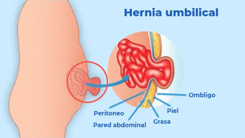 Hernia umbilical