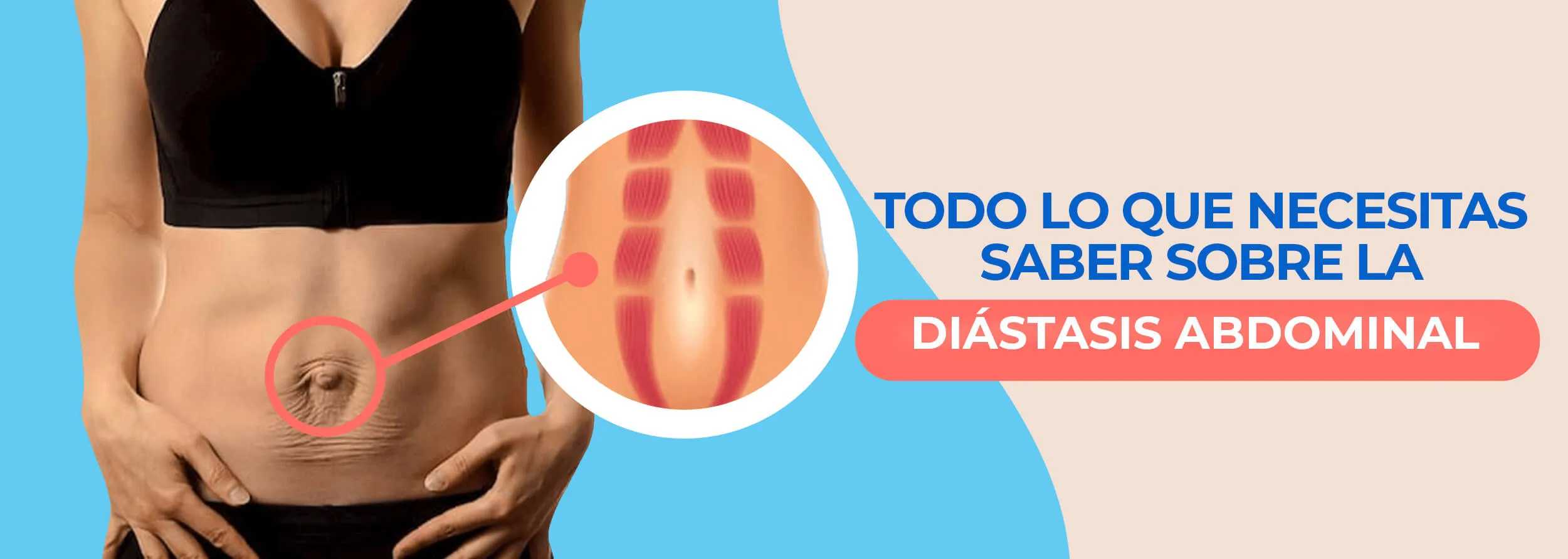 Todo lo que Necesitas Saber Sobre la Diástasis Abdominal