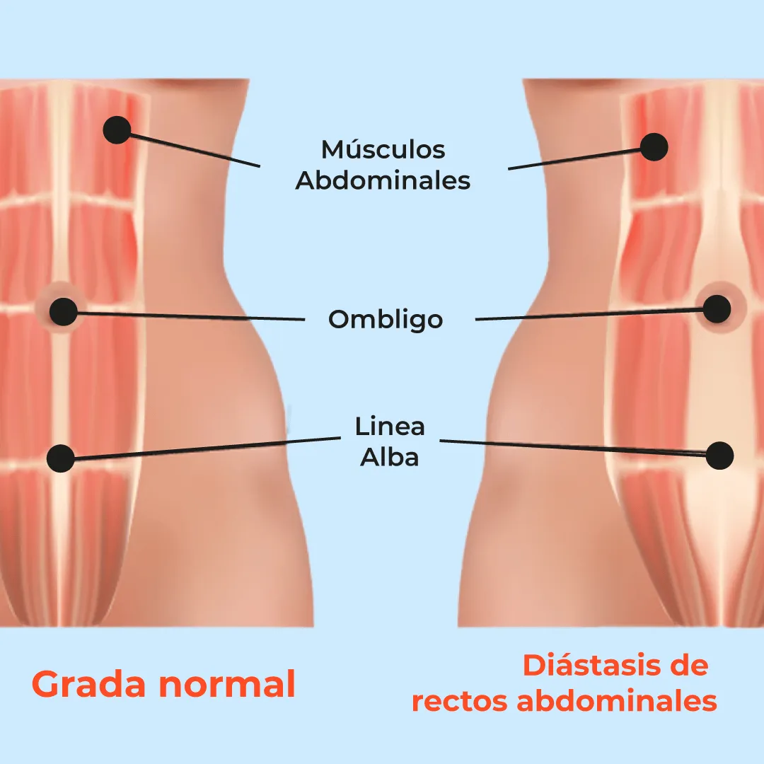 diastasis abdominal