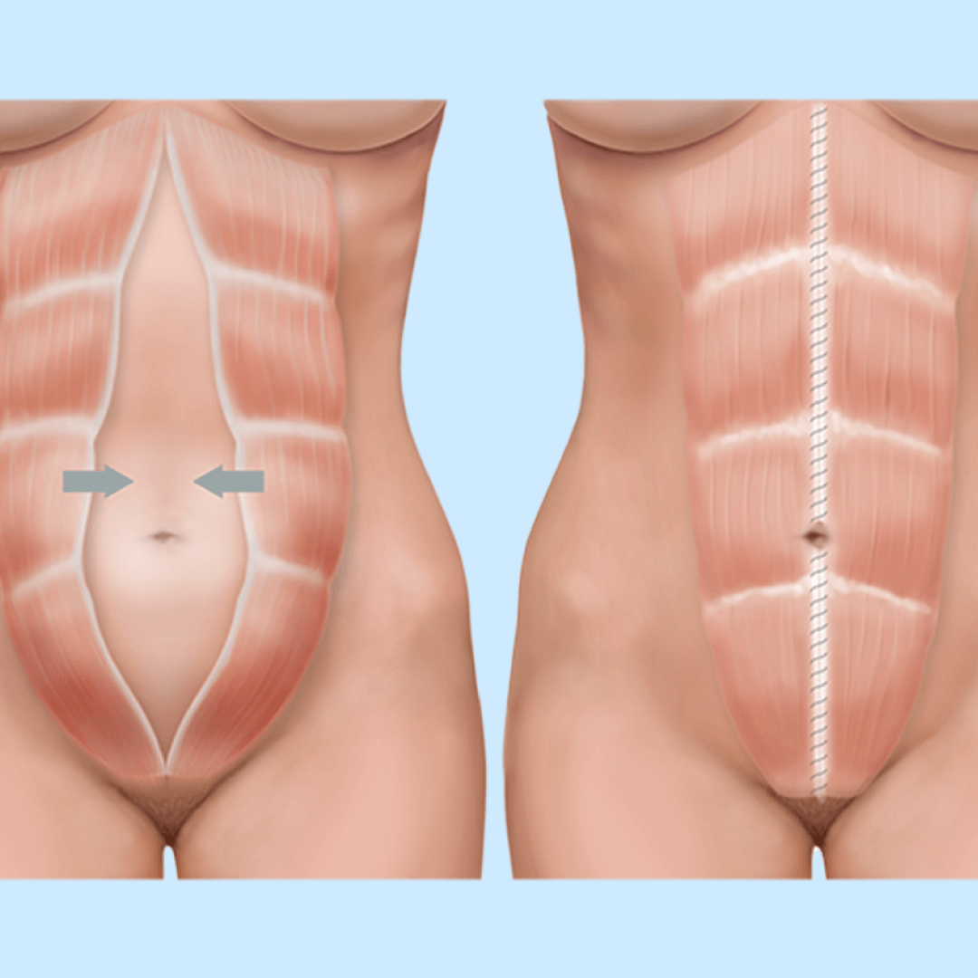 Cirugía para Diastasis abdominal