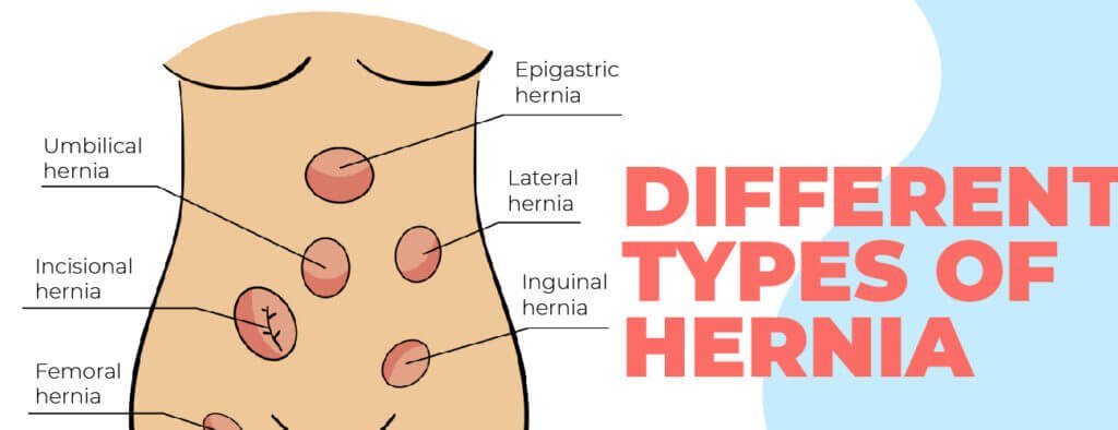 Types of hernia Different types of hernia.