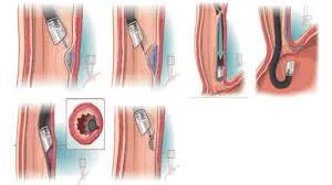 Acalasia