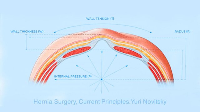 Abdominal Wall Reconstruction