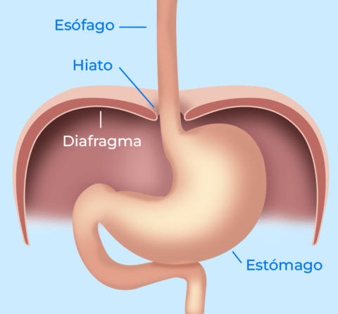 hernia hiatal normal