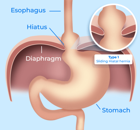 hiatal hernia type 1