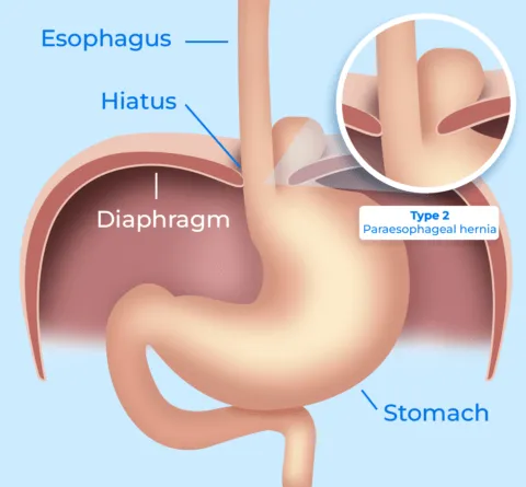 Hiatal hernia type 2