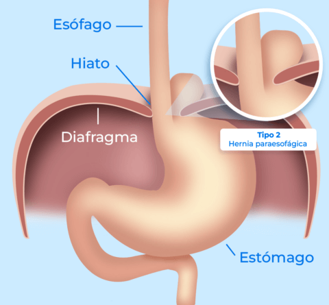 Tipo 2: Hernia paraesofágica